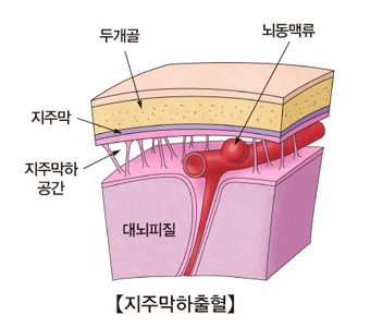 지주막하출혈-대뇌피질,지주막하공간,지주막,두개골,뇌동맥류위치