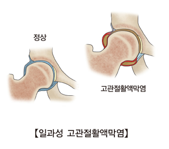 정상소아의 관절과 고관절할액막염에 걸린 소아의 관절