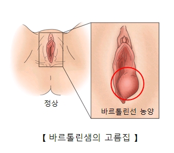 바르톨린샘의 고름집-정상여성의 성기와  바르톨린선 농양으로 염증이 발병된 여성의 성기