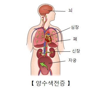 양수색전증-모체순환으로 들어간 그림예시및, 뇌,심장,폐,신장,자궁의 위치