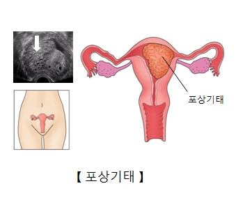 포상기태의 그림예시및 초음파 검사 사진