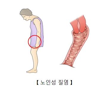 노인성 질염-할머니의 질 그림 예시