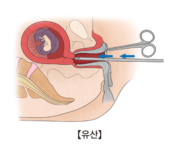 유산-소파술로 태아와 부속물을 긁어내고 있음