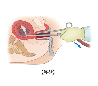 유산-수일에서 수 주동안 사망한 임신산물을 빼고 있는 모습 예시