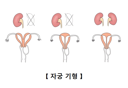 자궁 기형의 그림 예시