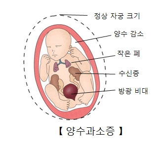 양수과소증-정상자궁크기,양수감소, 뱃속태아의 작은폐,수신증,방광비대 그림 예시