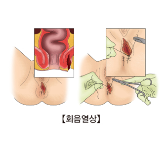 회음열상-회음열상이 발병된 여성의 성기 그림 및 치료모습 예시