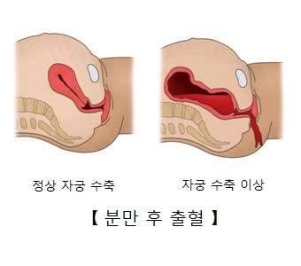 분만후출혈-정상자궁수축과 자궁수축이상의 그림 예시