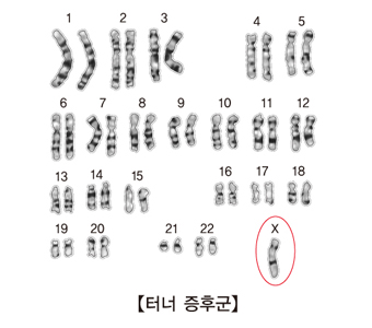 터너 증후군의 염색체(X염색체가하나밖에없음)