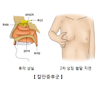 후세포 상비갑계 후신경 목구멍 경구개의 위치 및 후각상실 2차성징발달지연의 원인인 칼만증후군의 예시