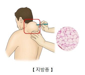 목주변의 지방종이 부풀러 오른 예시 및 지방종세포 예시