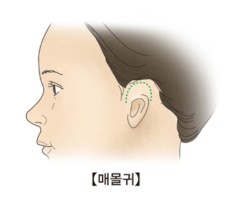 모양이 온전한 귀의 일부(윗쪽)가 피부밑에 묻혀있는 매몰귀 사진 예시