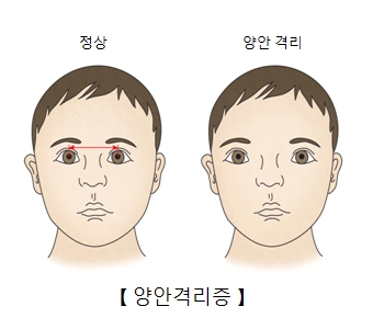 정상 및 양안격리증의 차이점 예시