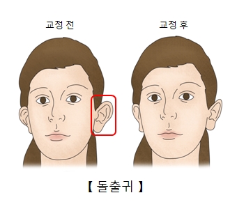 돌출귀 교정전 및 교정후 차이 예시