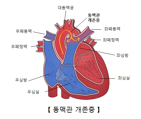 대동맥궁 동맥관개존증 좌폐동맥 좌폐정맥 좌심방 좌심실 우심실 우심방 우폐정맥 우폐동맥의 위치를 나타낸 동맥관 개존증의 예시