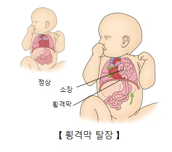 정상적인 유아의 모습과 횡격막 탈장으로 인해 소장 및 횡격막에 이상이 있는 유아의 모습