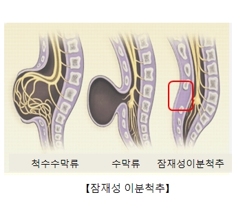 척수수막류 수막류 잠재성이분척추등 잠재성이분척추의 대한 예시