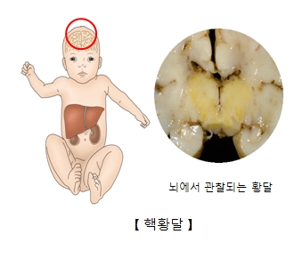 뇌에서 관찰되는 황달 및 핵황달에 대한 예시