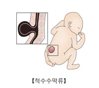 척수수막류의 대한 예시