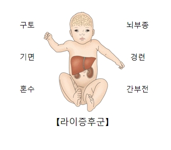 구토 뇌부종 기면 경련 혼수 간부전등 라이증후군의 대한 예시