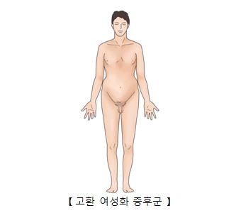 고환 여성화 증후군의 대한 예시