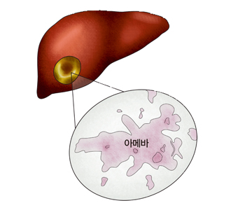 아메바성 간농양의 대한 예시
