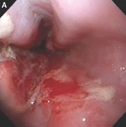 내시경으로 바라본 식도염의 예시