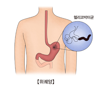 헬리코박터균으로 위궤양이 발생되는 예시