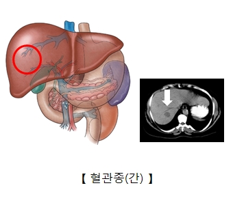 혈관종(간)의 대한 예시 및 CT로 찰영한 혈관종의 대한 예시