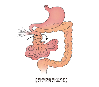 장염전(장꼬임)의 대한 예시