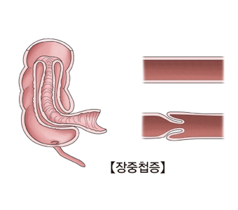 장중첩증의 대한 예시