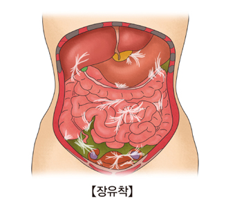 장유착의 대한 예시