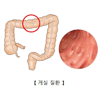 게실 질환의 예시