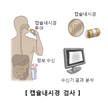 캡슐내시경 캡슐내시경을 투여 정보수신 수신기 결과분석등 캡슐내시경 검사의 예시