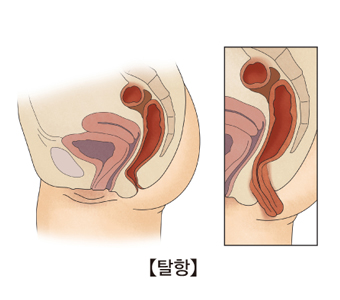 탈항의 대한 예시