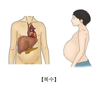 복수의 대한 예시및 복수로 인해 배가 튀어나온 남성