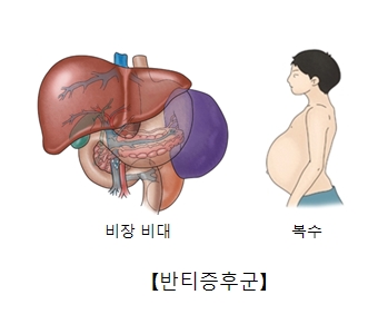 비장비대와 복수에 걸린 남성및 반티증후군의 예시 