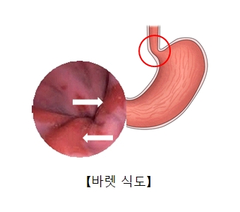 바렛 식도의 예시