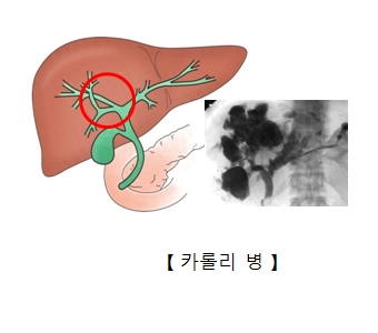 카롤리 병의 대한 예시