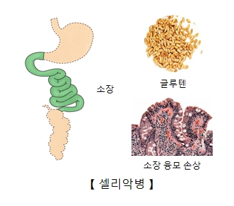 소장 글루텐 소장융모손상등 셀리악병의 대한 예시