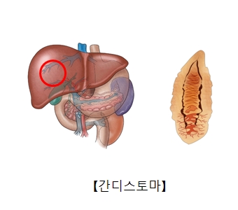 간디스토마의 대한 예시