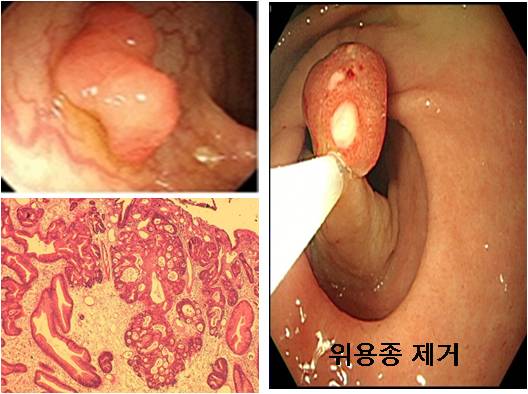 위용종및 위용종 제거에 대한 예시