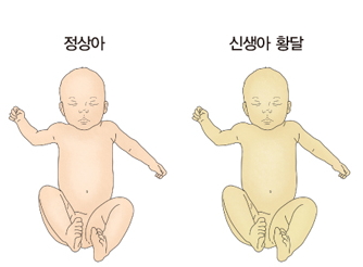 정상아와 황달이 발생한 신생아 황달의 차이점 예시