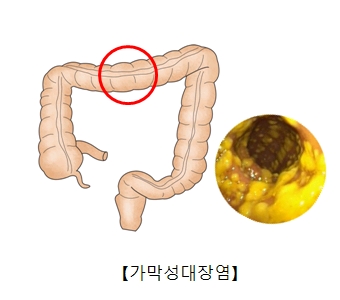 가막성대장염의 대한 예시