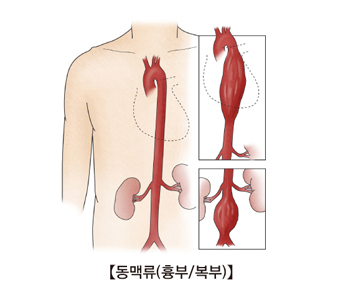 동맥류(흉부/복부)의 예시