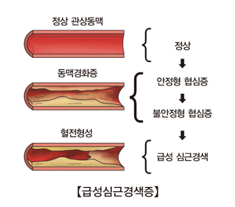 정상 관상동맥 동맥경화증 혈전형성은 정상 안정혈 협심증 불안정혈 협심증 급성 심근경색등의 순서로 발생되는 급성심근경색증의 예시