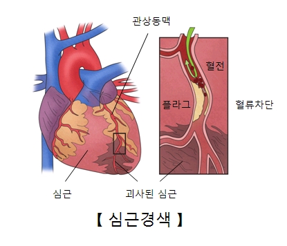 심근 관상동맥 괴사된 심근 혈전 플라그 혈류차단등 심근경색의 예시