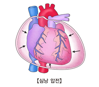 심낭 압전의 예시