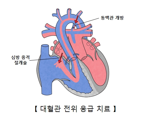 동맥관 개방 심방중격 절개술을 필요로 하는 대혈관 전위 응급치료의 예시