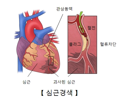 
심근 관상동맥 괴사된 심근 혈전 플라그 혈류차단등 심근경색의 예시